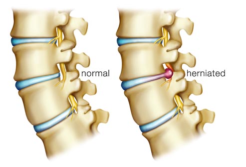 Image result for cervical spine disc prolapse
