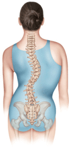 scoliosis