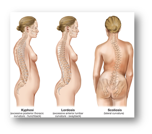 3 Scoliosis Types