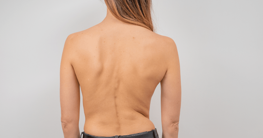 Scoliosis