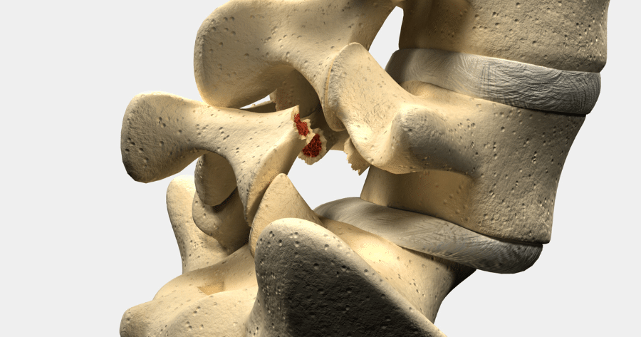 Spondylolisthesis Specialist in Houston & Beaumont, TX Spondylolisthesis Specialist in Houston & Beaumont, TX<br />