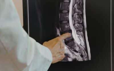 What Is Spinal Instability and How Is It Diagnosed?