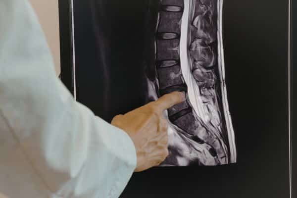 What Is Spinal Instability and How Is It Diagnosed